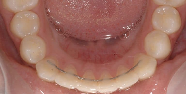 “MAMA, MIJN DRAADJE IS LOS”